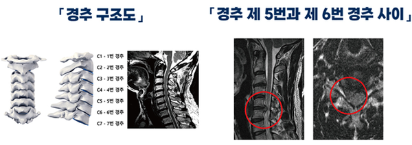 유성성형외과 목디스크가 걱정된다면