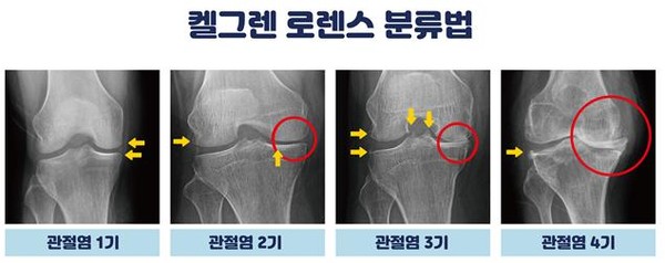 켈그렌 로렌스 분류법. 대전우리병원 제공