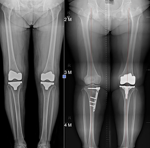 인공관절수술 후 관절의 모습과 절골술과 인공관절수술을 통한 정확한 다리 정렬. 인공관절의 수명은 평균적으로 15년, 잘 사용하면 20년까지도 사용이 가능하며, 수술 후 한달 정도의 적극적이 재활치료와, 6개월가량의 근력운동 (걷기, 실내용 자전거 타기등)을 꾸준히 하시면 통증 없이 건강한 다리를 유지할 수 있다. 대전우리병원 제공